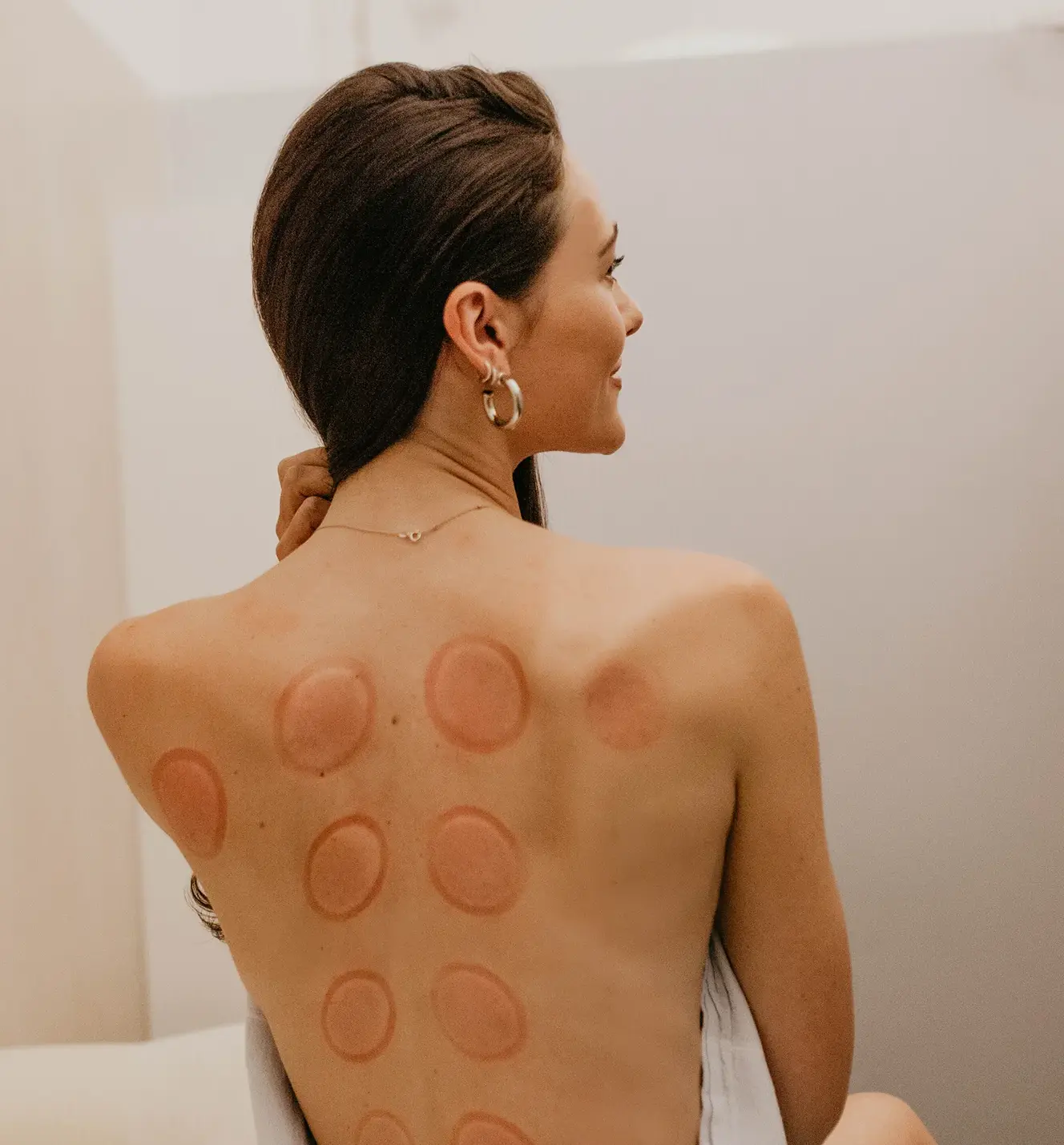 cupping therapy